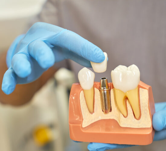 Dental Implants